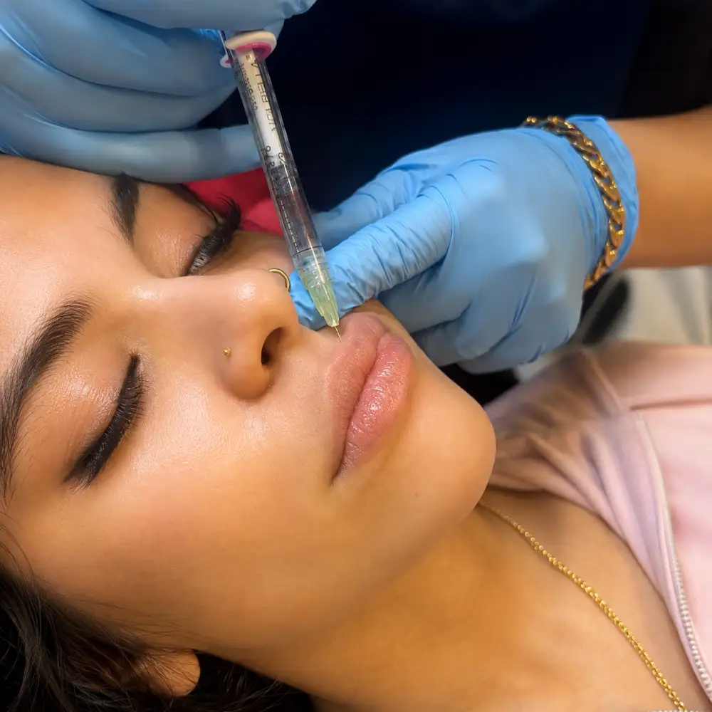 Lip Fillers Treatment at Glow Spot Med Spa